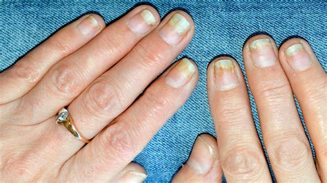 Psoriatic Arthritis Nail Damage A Guide Everyday Health