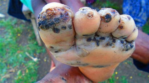 Jigger Flea Plague Infests Africa! - YouTube