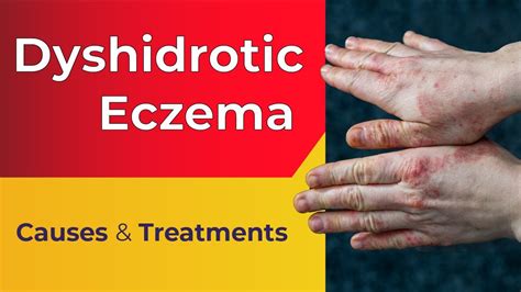 What Is Dyshidrotic Eczema How To Identify And Treat Vrogue Co