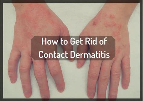 How I Got Rid Of Itchy Contact Dermatitis The Natural Way Remedygrove