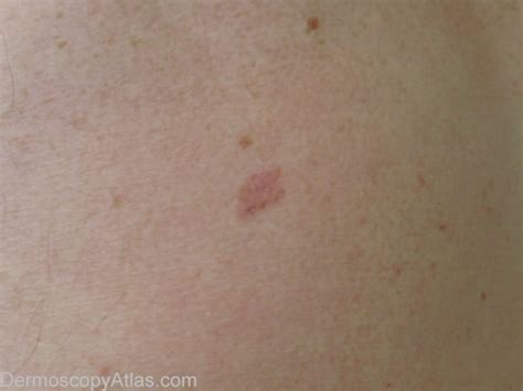 Pictures Of Melanoma On Leg Pictures Photos