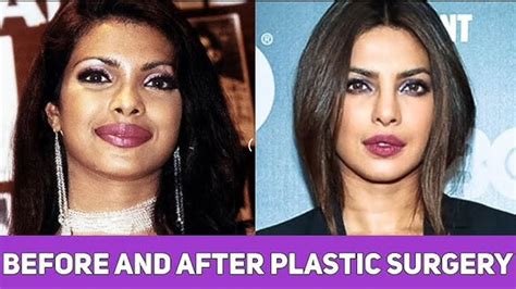 Bollywood Actresses Before And After Plastic Surgery Bollywood News