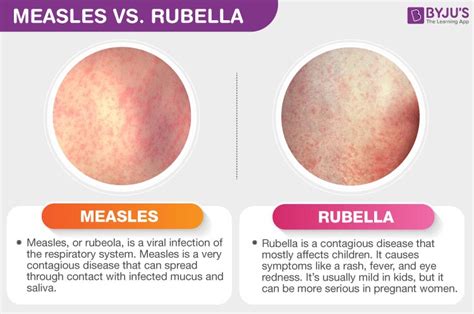 Difference Betwen Measles And Rubella Measles Vs Rubella Byjus