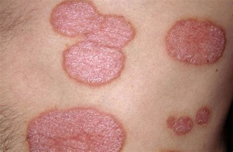 What Does Plaque Psoriasis Look Like Symptoms And Pictures
