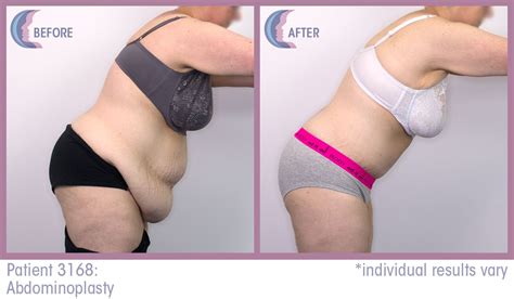 Amazing Tummy Tuck Before And Afters Tummy Tucks Liposuction Tummy
