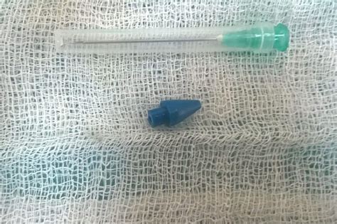 Man Gets Pen Tip Removed From Penis After Sex Act Gone Wrong