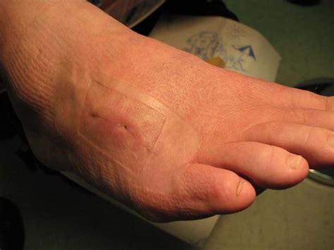 Stingray Envenomation Of The Foot A Case Report The Foot And Ankle