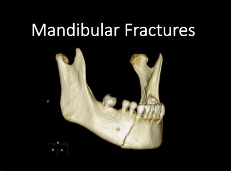 Disloacted Jaw And Multiple Facial Fractures Telegraph