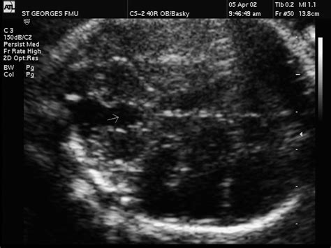 Us Fetal Scan Showing A Dandy Walker Variant Download Scientific