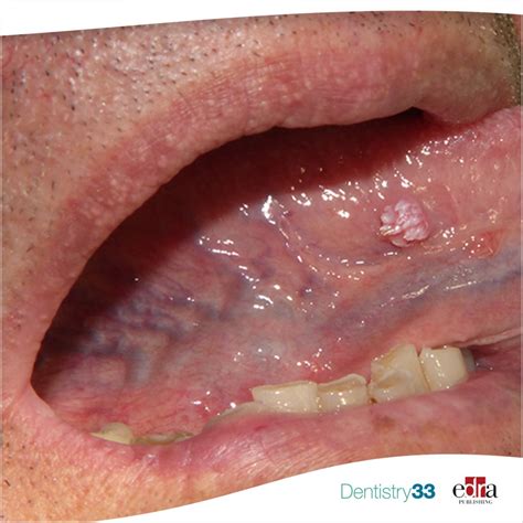 Papillary White Excrescence On The Tongue A Clinical Case Dentistry