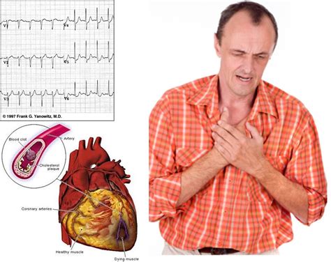 Cuida Tu Corazón Infarto Agudo Al Miocardio