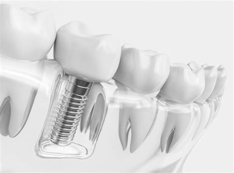 What You Need To Know About Dental Implant Surgery Pediatric Dentist