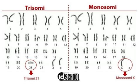 Kelainan Jumlah Kromosom Trisomi Dan Monosomi