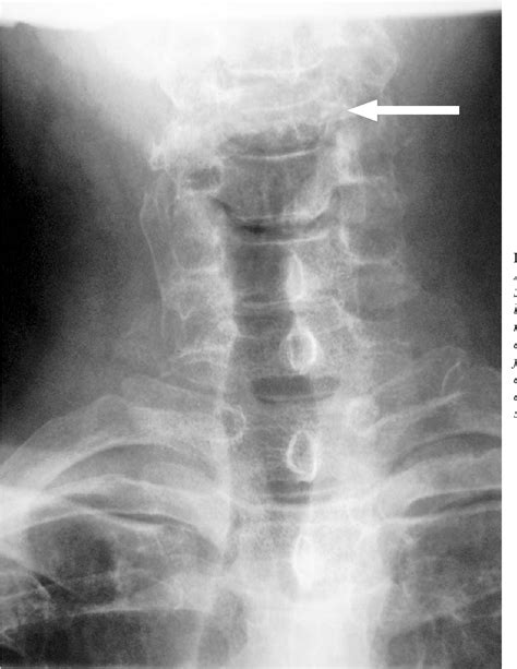Pdf Pathological Burst Fracture In The Cervical Spine With Negative