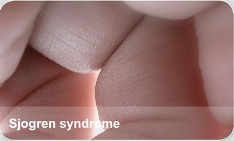 Connective Tissue Diseases Sjogren Syndrome Elabscience