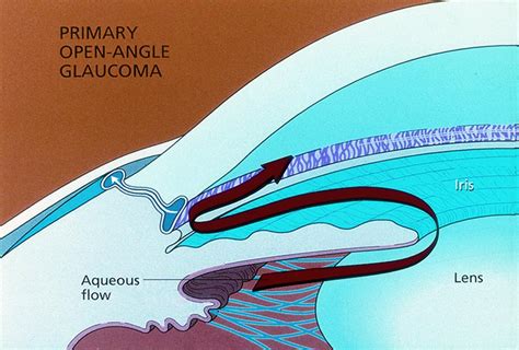 Schematic Of Open Angle Glaucoma American Academy Of Ophthalmology