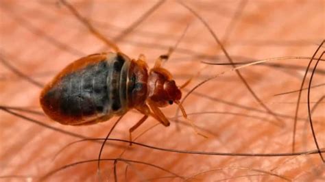Bed Bugs In Hair Symptoms Pictures And Treatment For Bugs In Hair