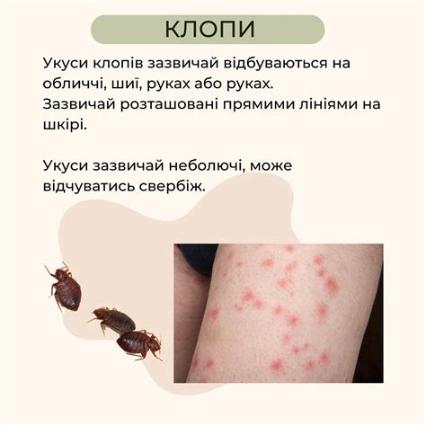 Симптомы укуса комара блох пчел как их распознать РБК Украина