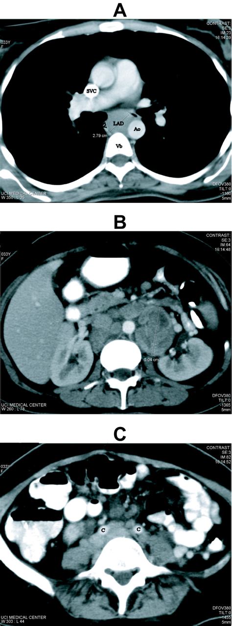 Computed Tomography At Presentation Panel A Chest Ct Demonstrating
