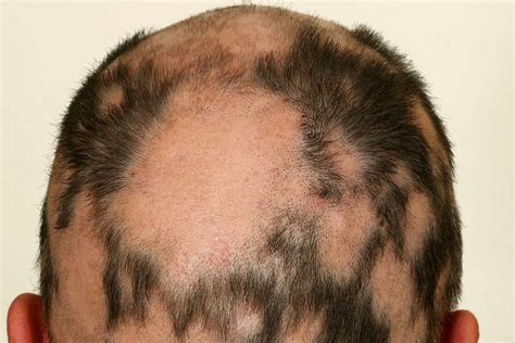 Alopecia areata Causas diagnóstico y tratamientos