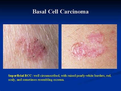 Dermatology For Primary Care Recognizing Common Skin Tumors