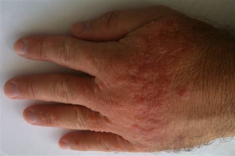 Mind Body Thoughts Healing The Itchy Hand Rash Day 9