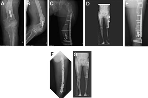 A B A 65 Year Old Male With Femoral Malunion And Shortening Of The