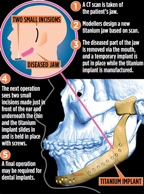Jaw Cancer Patients Spared Misery Of Facial Disfigurement Daily Mail