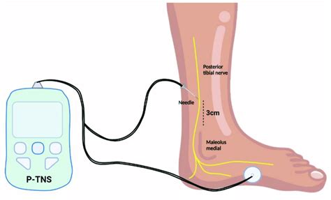 Illustration Of The Electrodes And Needle Position For Percutaneous