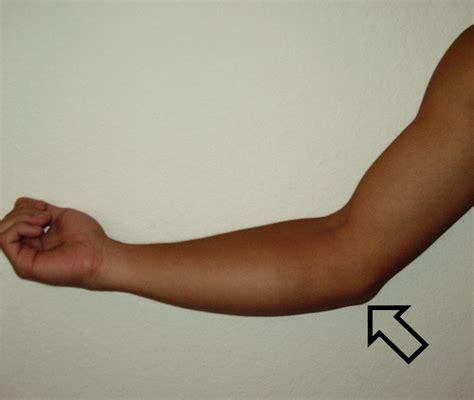 Signs Symptoms Ulnar Collateral Ligament Sprain 22795 Hot Sex Picture