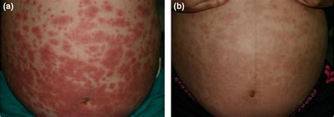 Pruritic Urticarial Papules And Plaques Of Pregnancy Slidesharetrick
