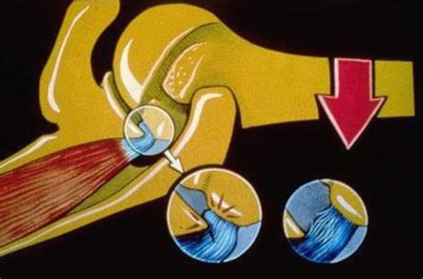 Shoulder Impingement 3 Keys To The Evaluation And Treatment Mike