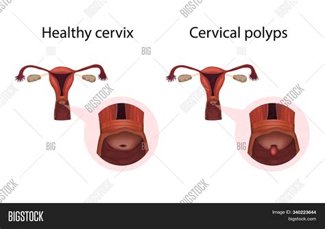 Cervix Polyps Healthy Image And Photo Free Trial Bigstock