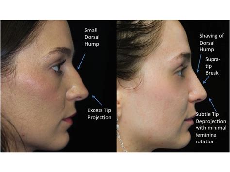 A Comprehensive Guide To Natural Rhinoplasty Beverly Hills