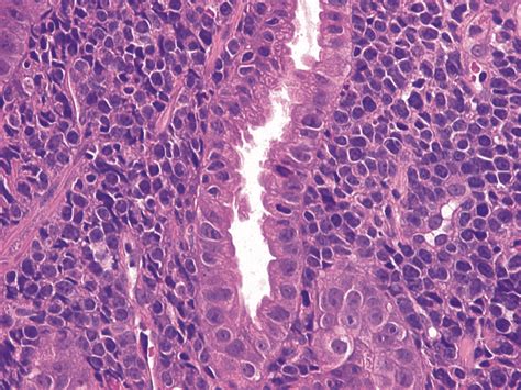 Primary Gastric Diffuse Large B Cell Lymphoma With Malt Component
