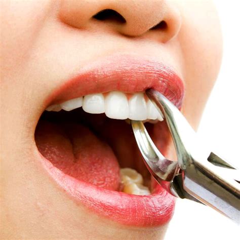 Painless Dental Extractions Dr Pradnya Rivankar Perfect Smile