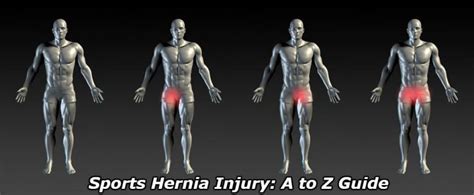 Physiqz Can A Sports Hernia Get Worse Dont Make This 1 Mistake