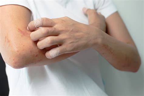 Dupixent First Biologic Approved For Atopic Dermatitis