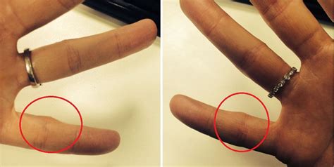 Has your smartphone given you 'smartphone pinky'? | Metro News
