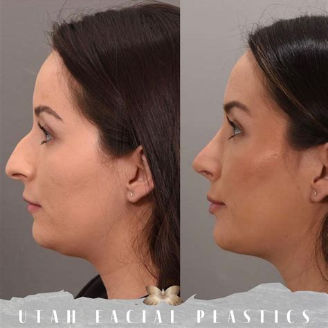 Add Definition To Your Jawline And Chin With Deep Neck Contouring