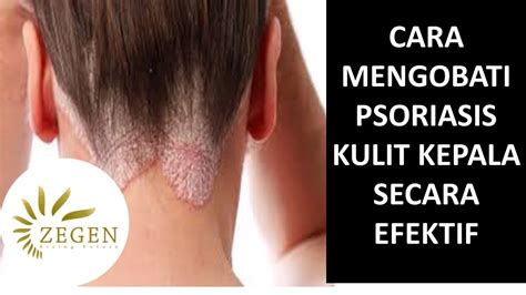 Cara Mengobati Psoriasis Di Kulit Kepala