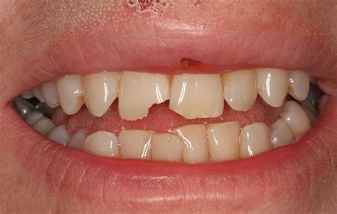 Tooth Coloured Fillings Dentists In Horley Gatwick Crawley And Redhill