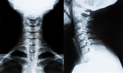 Whiplash Chiropractor Loss Of Cervical Lordosis Ep Wellness