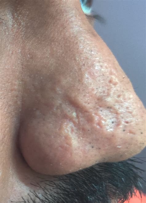 Need Help With Scarring Treatments And Doctors Scar Treatments