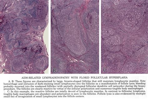 Pathology Outlines Follicular Hyperplasia