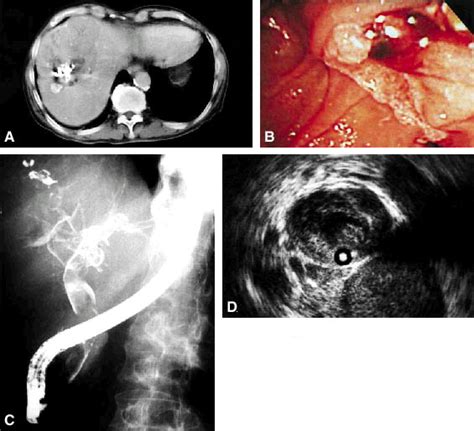 Acute Pancreatitis Caused By Hemobilia Secondary To Hepatoma With Bile