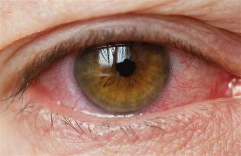 Ojos Rojos Qué Enfermedades Puede Haber Detrás Y Cómo Evitarlo