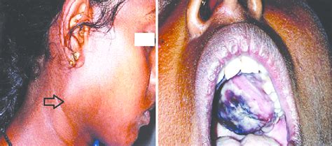 A Extra Oral View Depicting Cervical Lymphadenopathy Arrow Head B