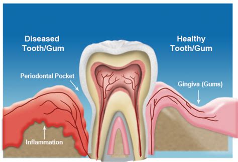 Why Are My Gums Swollen Behind My Teeth Teethwalls