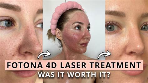 Was The Fotona 4D Laser Treatment Worth It Before After YouTube